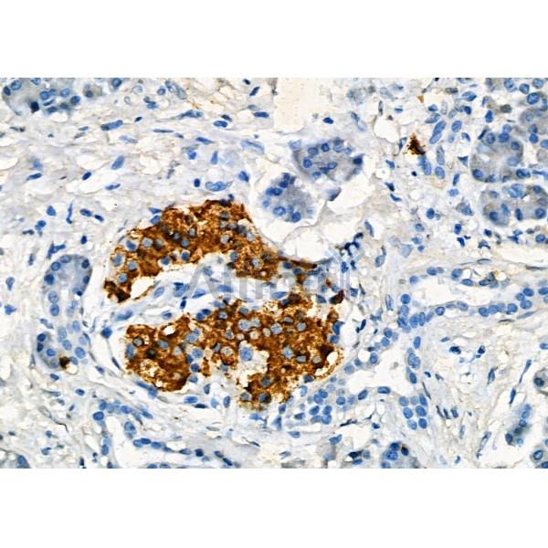 DAP Antibody - DF7628 at 1/100 staining Human pancreatic cancer and adjacent nomal tissues by IHC-P.