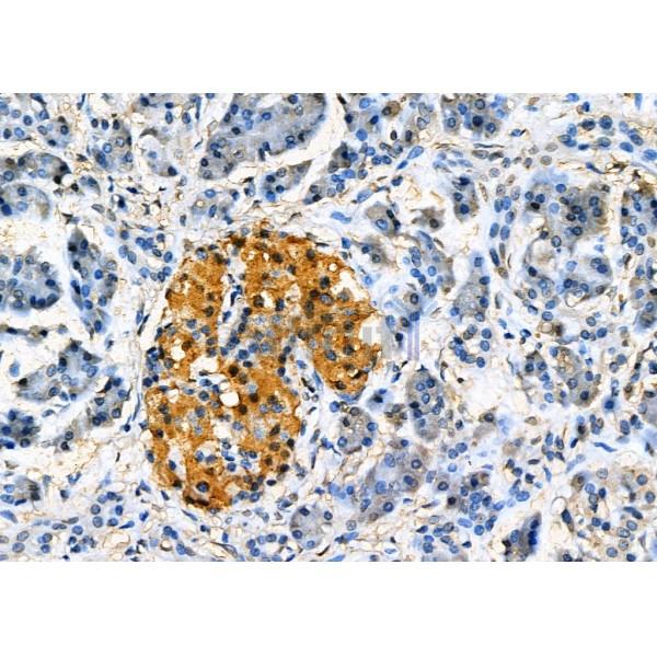 TMX2 Antibody - DF7629 at 1/100 staining Human pancreatic cancer and adjacent nomal tissues by IHC-P.