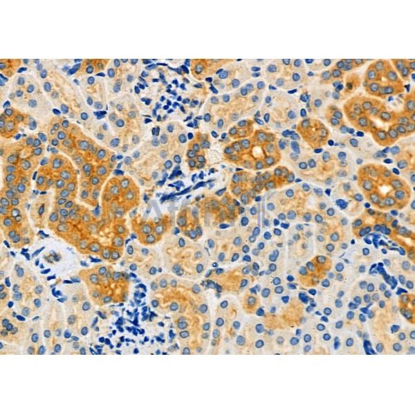 EPS15L1 Antibody - DF7681 at 1/100 staining Human kidney cancer by IHC-P.