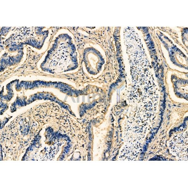 DNAJC3 Antibody - DF7685 at 1/100 staining Human prostate cancer by IHC-P.