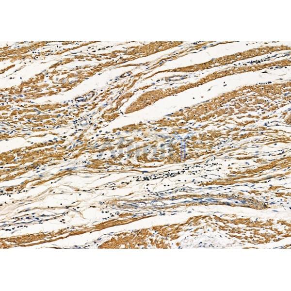Pannexin-3 Antibody - DF7721 at 1/100 staining Human colorectal cancer by IHC-P.