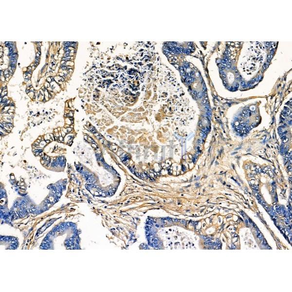 Pannexin-3 Antibody - DF7721 at 1/100 staining Human prostate cancer by IHC-P.
