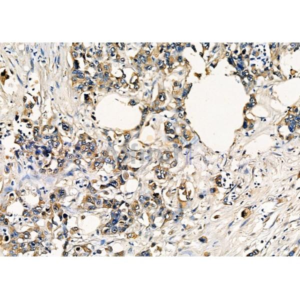 IGFBP2 Antibody - DF7765 at 1/100 staining Human gastric cancer by IHC-P.