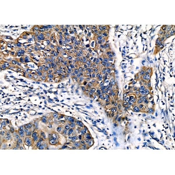 IGFBP2 Antibody - DF7765 at 1/100 staining Human esophageal cancer by IHC-P.