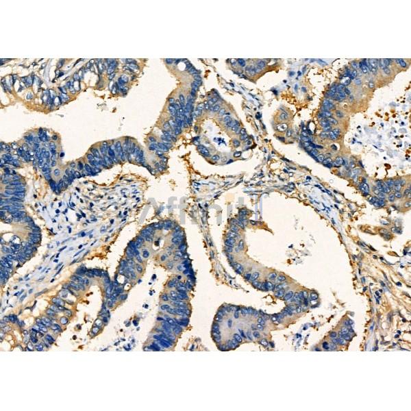 CGB Antibody - DF7923 at 1/100 staining Human prostate cancer by IHC-P.