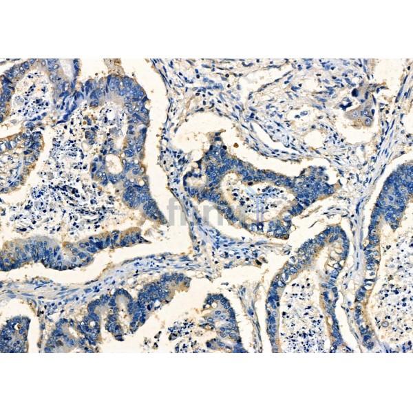 MSLN Antibody - DF7931 at 1/100 staining Human prostate cancer by IHC-P.