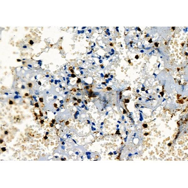 PIP Antibody - DF7933 at 1/100 staining Human lung cancer and adjacent normal tissues by IHC-P.