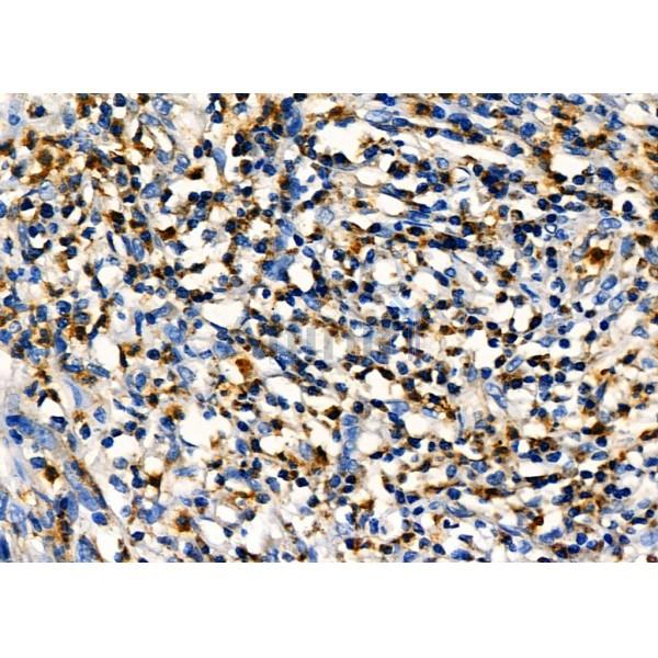 PIP Antibody - DF7933 at 1/100 staining Human lung cancer by IHC-P.