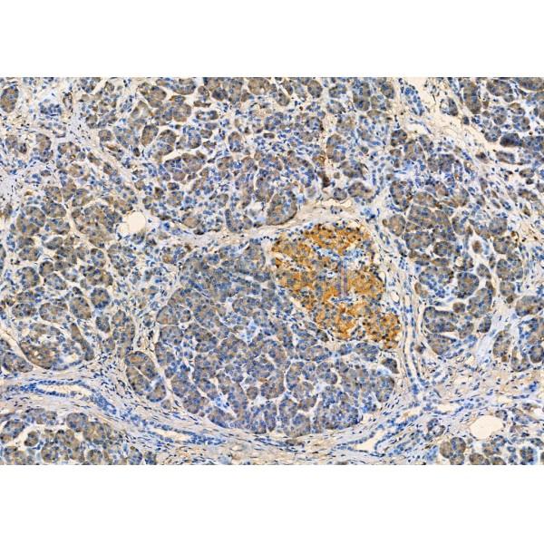 DSG3 Antibody - DF9439 at 1/100 staining Human pancreatic cancer and adjacent nomal tissues by IHC-P.