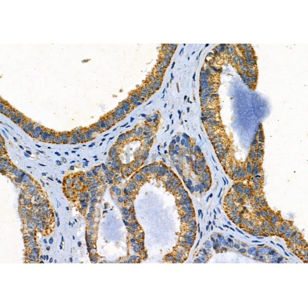Galectin 1 Antibody - DF2383 at 1/100 staining Human ovarian cancer by IHC-P.