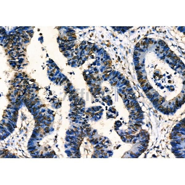 MRPS30 Antibody - DF4169 at 1/100 staining Human colorectal cancer by IHC-P.