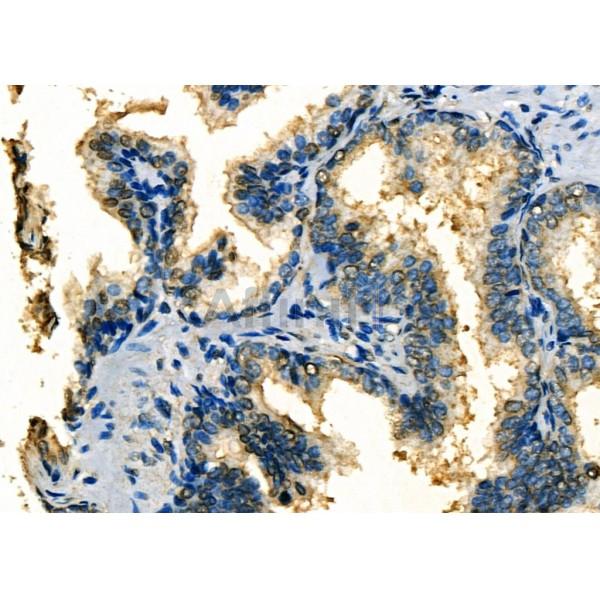 MRPS30 Antibody - DF4169 at 1/100 staining Human prostate cancer by IHC-P.