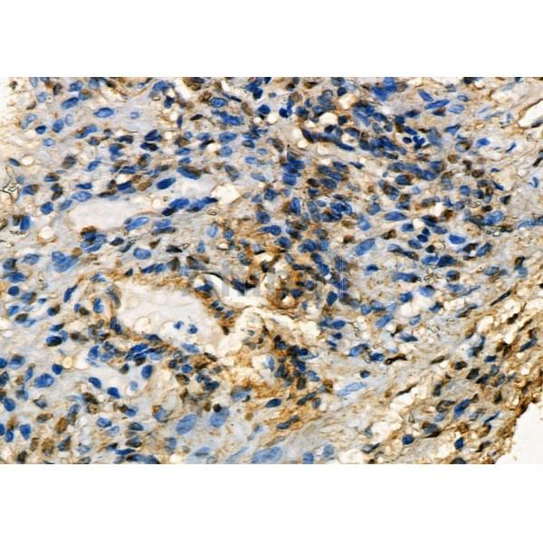 MRPS30 Antibody - DF4169 at 1/100 staining Human ovarian cancer and para-carcinoma tissue by IHC-P.