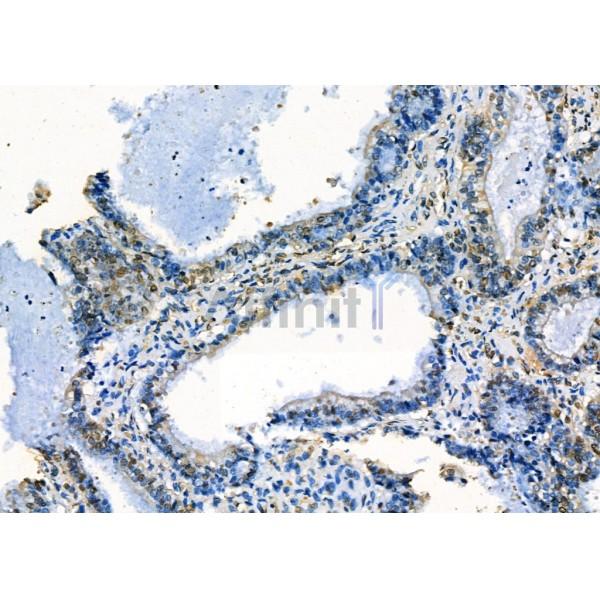 MRPS30 Antibody - DF4169 at 1/100 staining Human ovarian cancer by IHC-P.