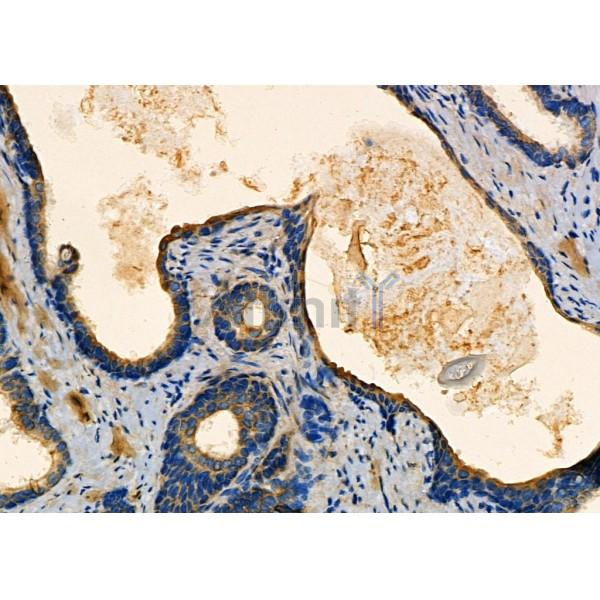 NDRG4 Antibody - DF4341 at 1/100 staining Human prostate cancer by IHC-P.