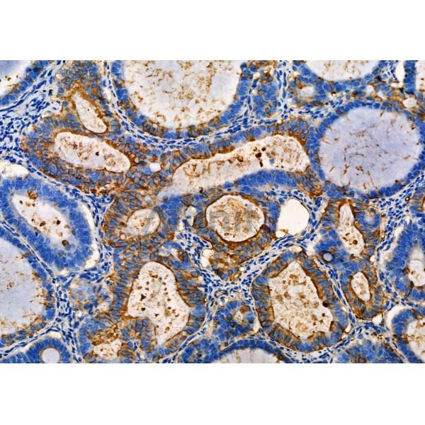 S100A5 Antibody - DF4355 at 1/100 staining Human ovarian cancer by IHC-P.