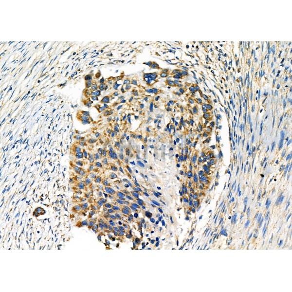 WNK3 Antibody - DF7407 at 1/100 staining Human esophageal cancer by IHC-P.