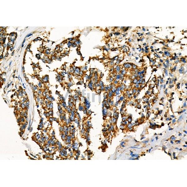 WNK3 Antibody - DF7407 at 1/100 staining Human ovarian cancer by IHC-P.