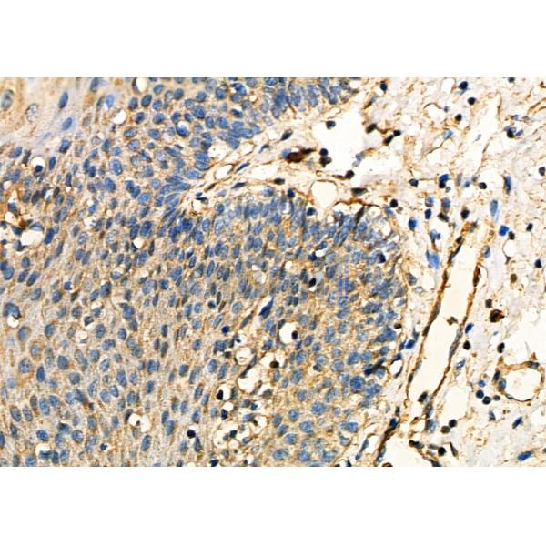 OCA2 Antibody - DF7439 at 1/100 staining Human esophageal cancer and para-carcinoma tissue by IHC-P.