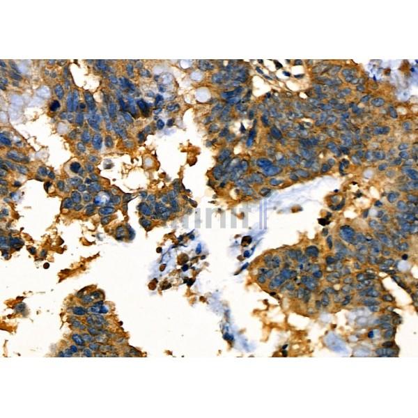 OCA2 Antibody - DF7439 at 1/100 staining Human ovarian cancer by IHC-P.