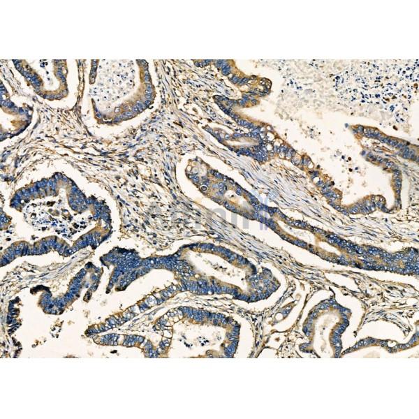 ENTPD5 Antibody - DF7901 at 1/100 staining Human prostate cancer by IHC-P.