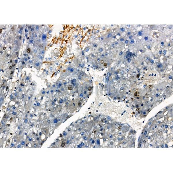 CD52 Antibody - DF8797 at 1/100 staining Human prostate cancer and para-carcinoma tissue by IHC-P.