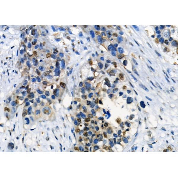 CD52 Antibody - DF8797 at 1/100 staining Human gastric cancer by IHC-P.