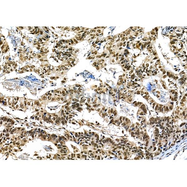 BCL9 Antibody - DF12515 at 1/100 staining Human pancreatic cancer by IHC-P.
