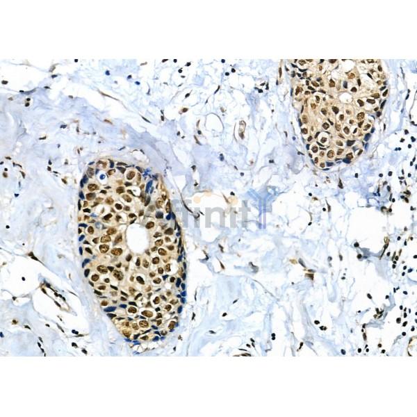 BCL9 Antibody - DF12515 at 1/100 staining Human lung cancer by IHC-P.