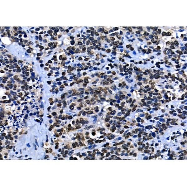 BCL9 Antibody - DF12515 at 1/100 staining Human liver cancer by IHC-P.