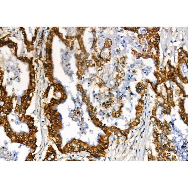 ARID3A Antibody - DF12558 at 1/100 staining Human gastric cancer by IHC-P.