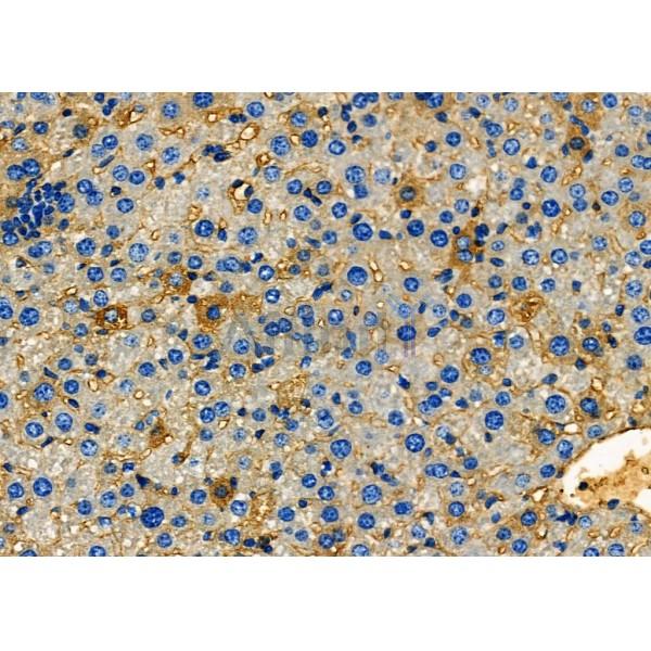 FcRn Antibody - DF12607 at 1/100 staining Human kidney cancer by IHC-P.