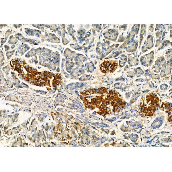 IMPDH1 Antibody - DF12642 at 1/100 staining Human gastric cancer and para-carcinoma tissue by IHC-P.