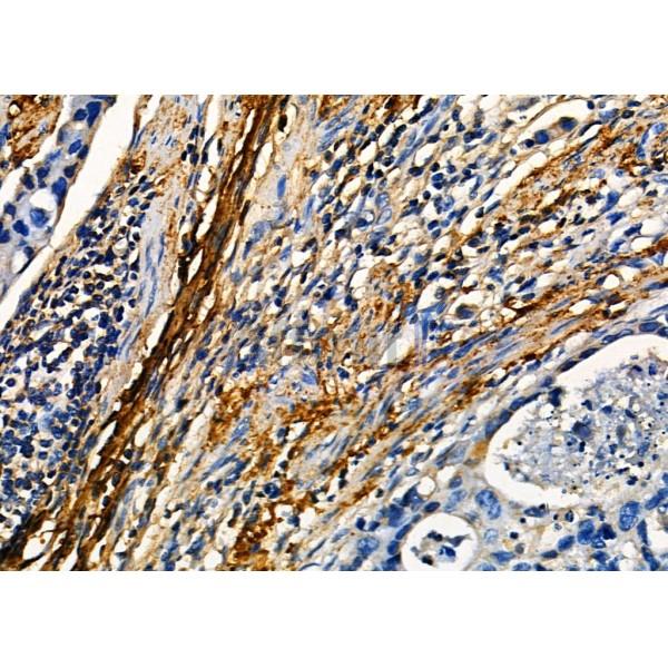 MFAP4 Antibody - DF12657 at 1/100 staining Human colorectal cancer by IHC-P.