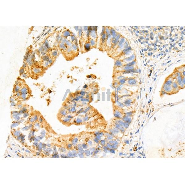 DNAJC5 Antibody - DF4011 at 1/100 staining Human pancreatic cancer by IHC-P.