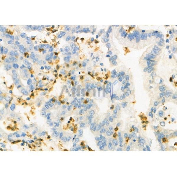 FOXD4 Antibody - DF4060 at 1/100 staining Human colorectal cancer by IHC-P.