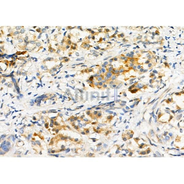 CDC42BPA Antibody - DF4786 at 1/100 staining Human pancreatic cancer and para-carcinoma tissue by IHC-P.