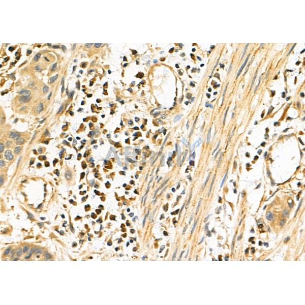 SLC44A1 Antibody - DF4805 at 1/100 staining Human esophageal cancer by IHC-P.