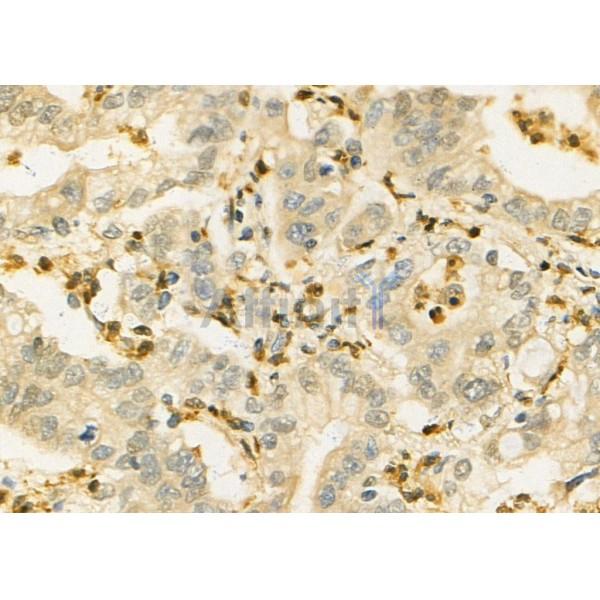 IL21 Antibody - DF4818 at 1/100 staining Human colorectal cancer by IHC-P.