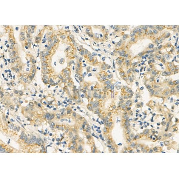 FAM3D Antibody - DF4832 at 1/100 staining Human colorectal cancer by IHC-P.