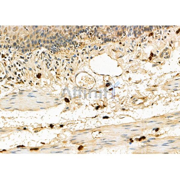EMR2 Antibody - DF4875 at 1/100 staining Human esophageal cancer and para-carcinoma tissue by IHC-P.