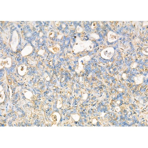 GPR17 Antibody - DF4966 at 1/100 staining Human liver cancer by IHC-P.