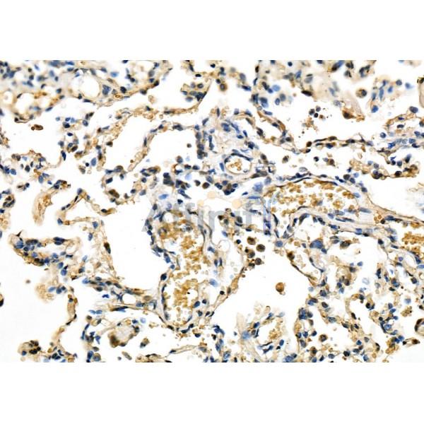 MXD3 Antibody - DF7986 at 1/100 staining Human lung cancer and para-carcinoma tissue by IHC-P.