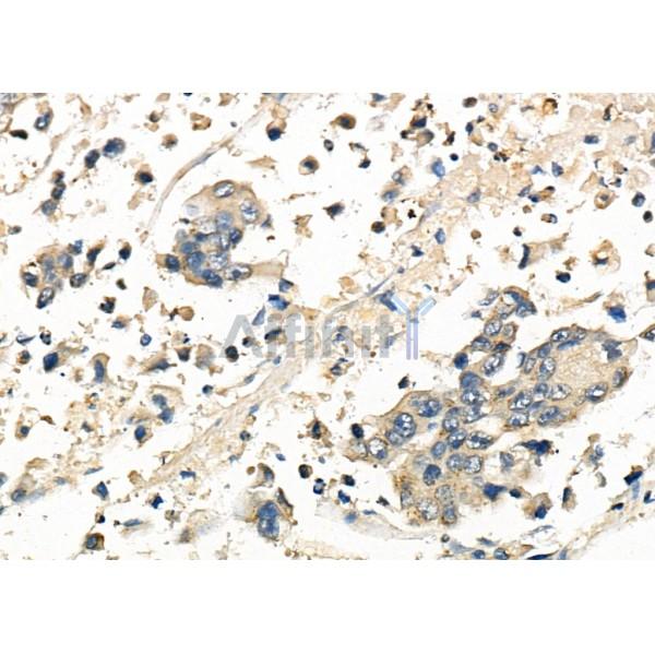 FRAT1 Antibody - DF8081 at 1/100 staining Human gastric cancer by IHC-P.