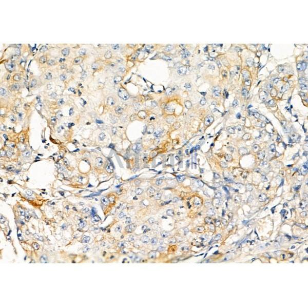 REM1 Antibody - DF8352 at 1/100 staining Human pancreatic cancer by IHC-P.