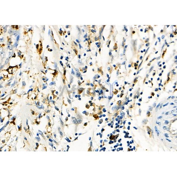 C1QTNF2 Antibody - DF8355 at 1/100 staining Human pancreatic cancer by IHC-P.