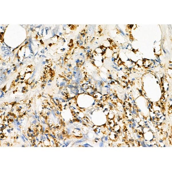 C1QTNF2 Antibody - DF8355 at 1/100 staining Human pancreatic cancer by IHC-P.