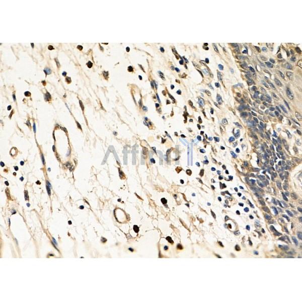 CLK4 Antibody - DF8645 at 1/100 staining Human esophageal cancer and para-carcinoma tissue by IHC-P.
