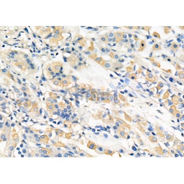 MBNL1 Antibody - DF8062 at 1/100 staining Human gastric cancer and para-carcinoma tissue by IHC-P.