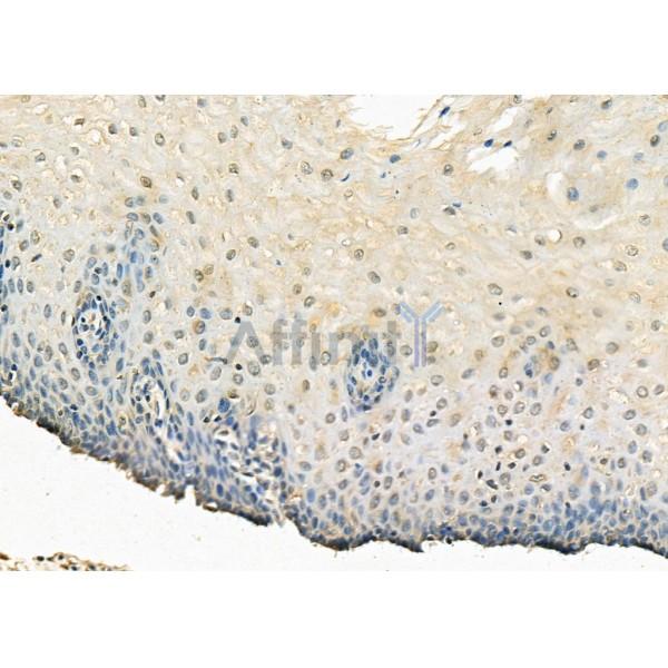 MBNL1 Antibody - DF8062 at 1/100 staining Human esophageal cancer and para-carcinoma tissue by IHC-P.